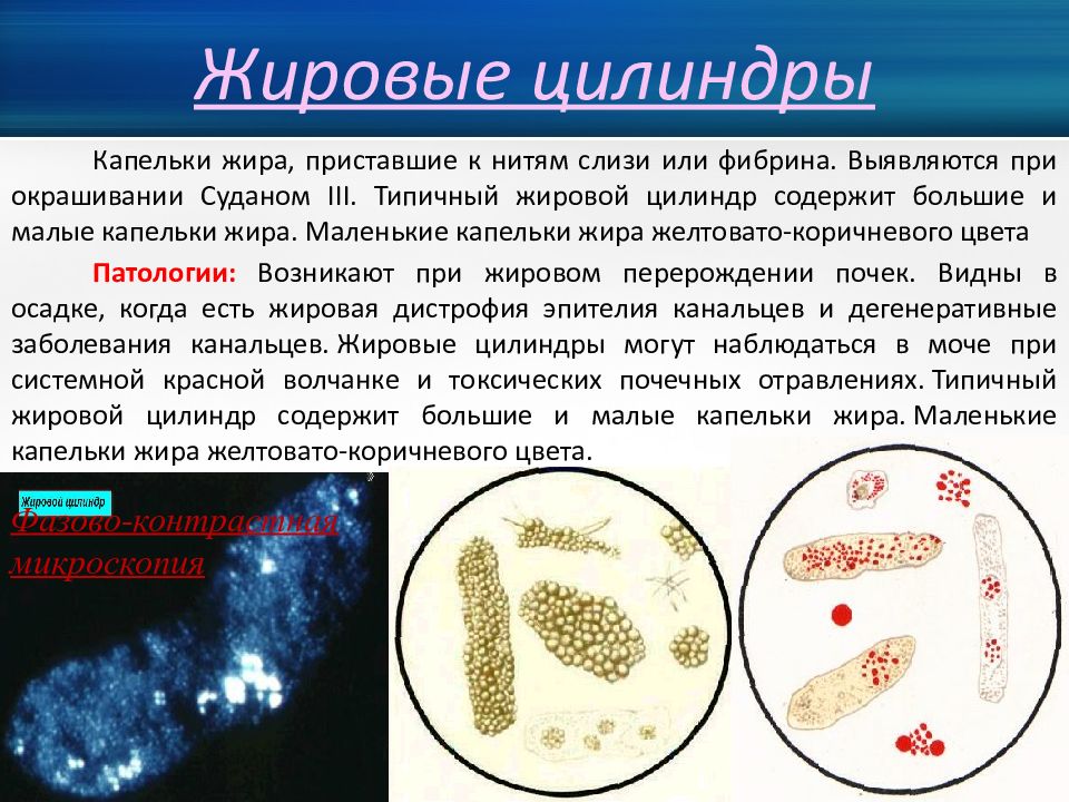 На наличие цилиндров при микроскопии осадка мочи указывает картина