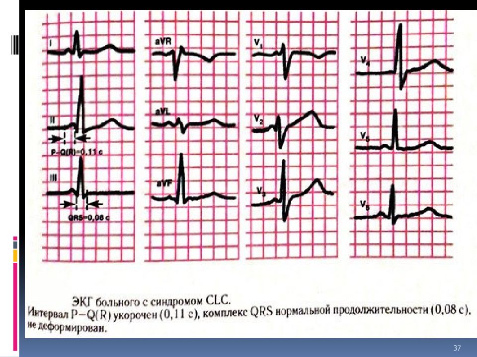 Экг опасно. CLC синдром. СРРЖ И Бругада разница на ЭКГ. Danon Syndrome ECG.