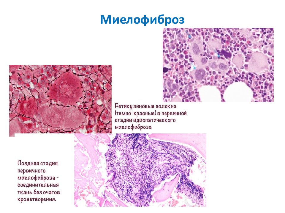 Миелофиброз это. Первичный миелофиброз гистология. Фиброзный костный мозг. Идиопатический миелофиброз картина крови. Патогенез первичного миелофиброза.