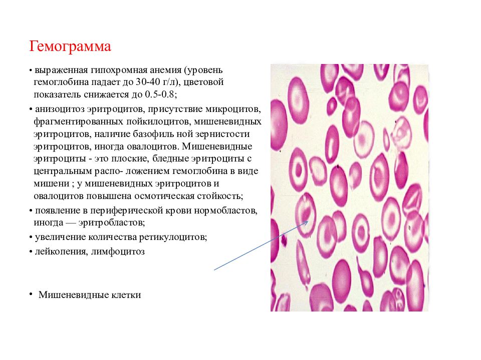 Коэффициент анизоцитоза эритроцитов повышен. Анизоцитоз эритроцитов. гемограмма анемии. микроциты. заключение по гемограмме.