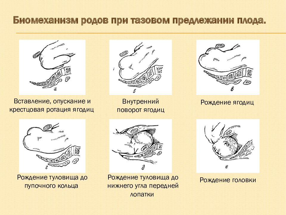 Тазовое предлежание плода презентация