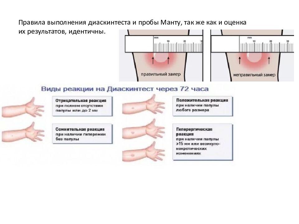 Диаскинтест можно ли. Реакция диаскинтест норма. Норма папулы при реакции манту у детей. Диаскинтест нормы и размер 5 лет. Папула после норма реакции манту.