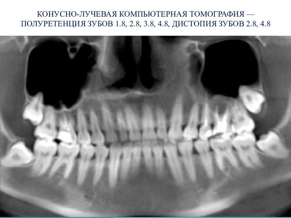 Зуб 3 8. Зуб мудрости ретенция дистопия.