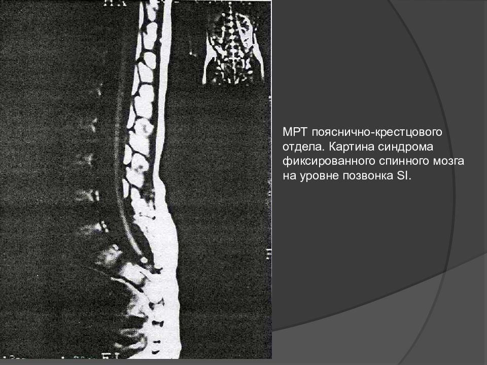 Спинномозговые грыжи презентация