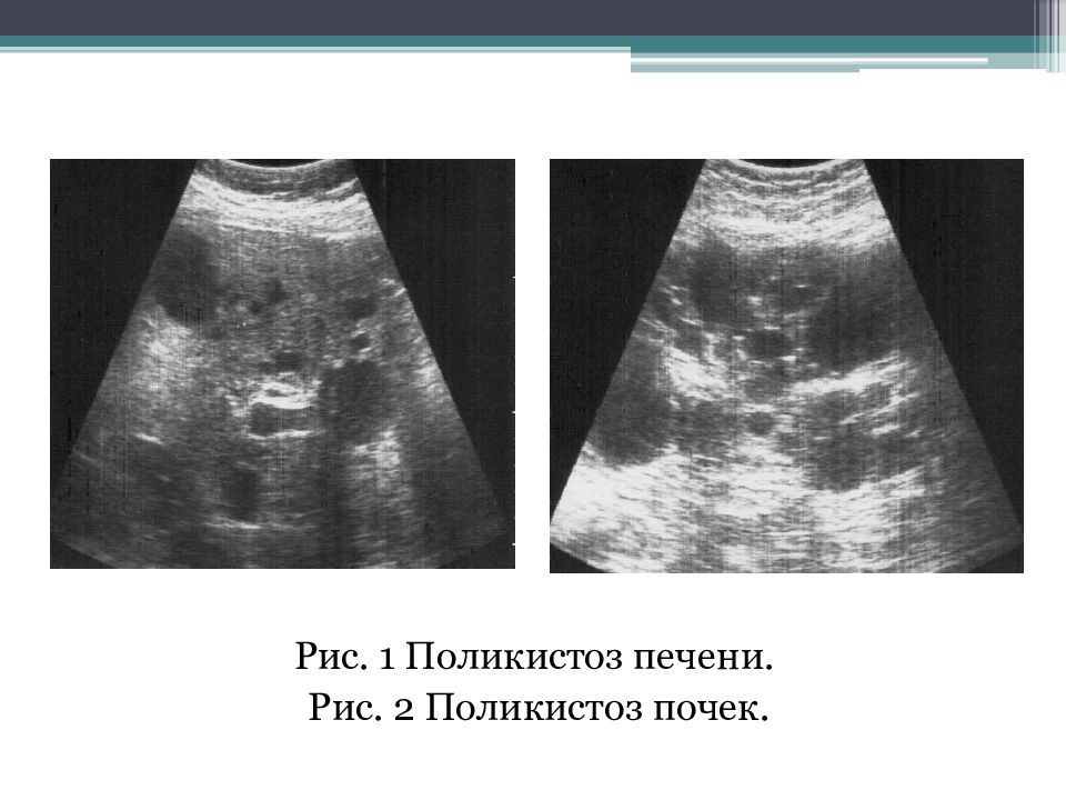 Поликистоз печени узи картина