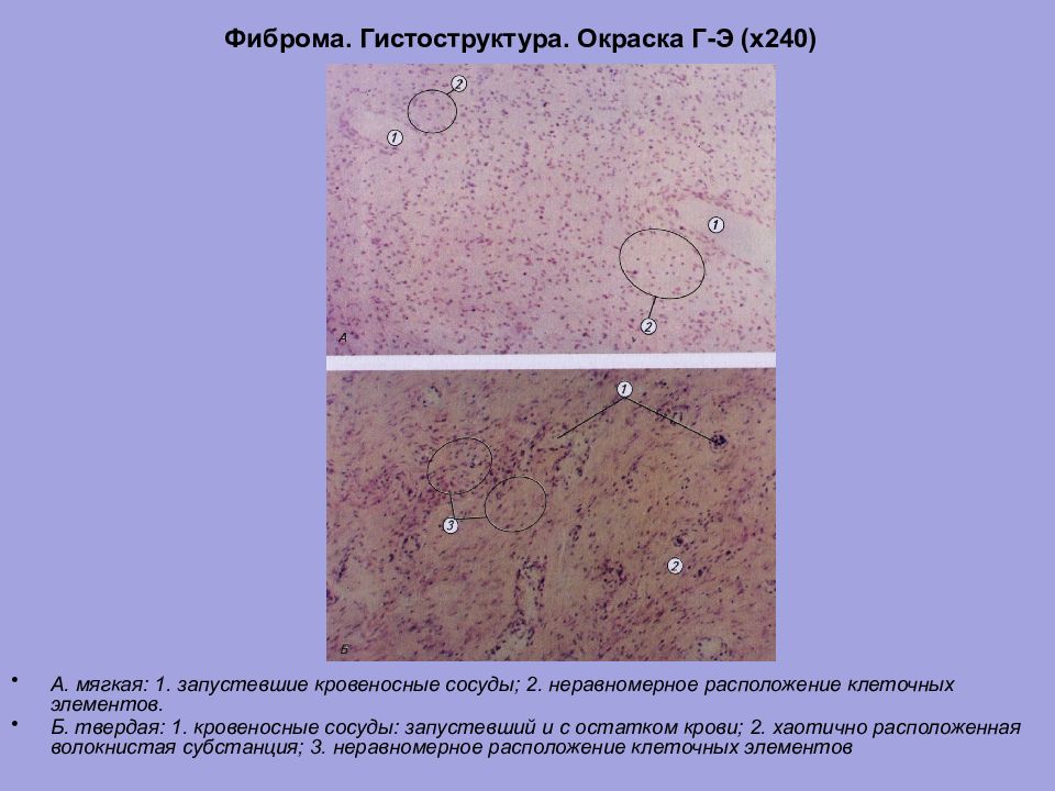 Фиброма микропрепарат рисунок