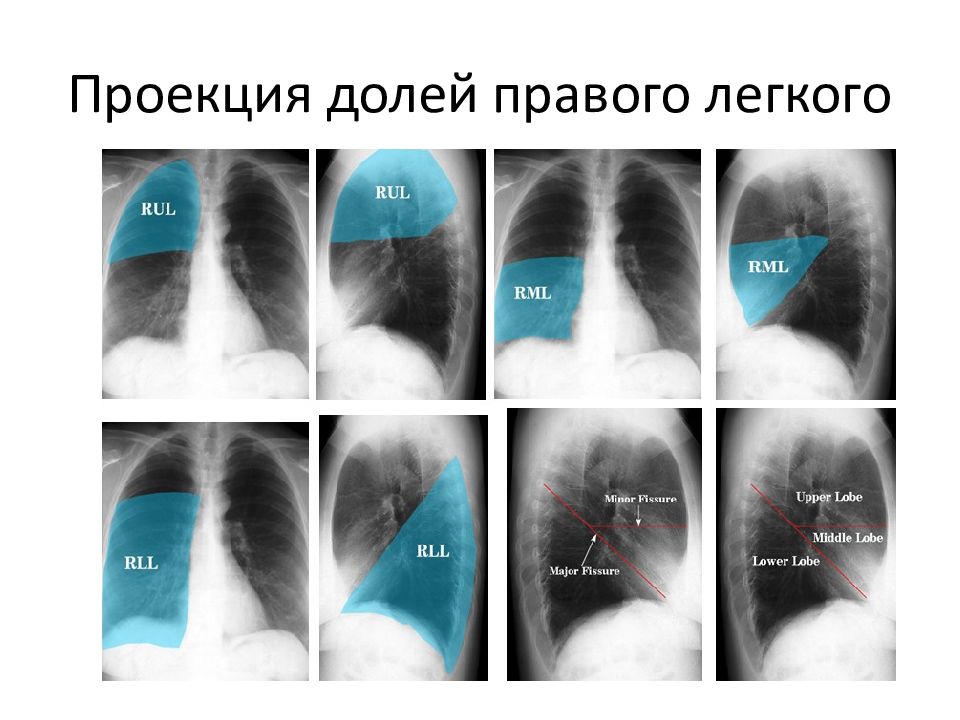 Сегменты легких на рентгенограмме схема