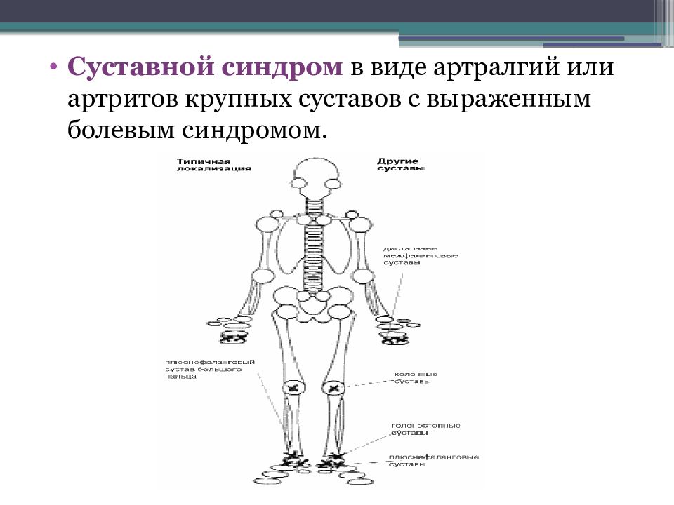 Суставной синдром. Артралгический синдром. Болевой суставной синдром. Суставной синдром типы.