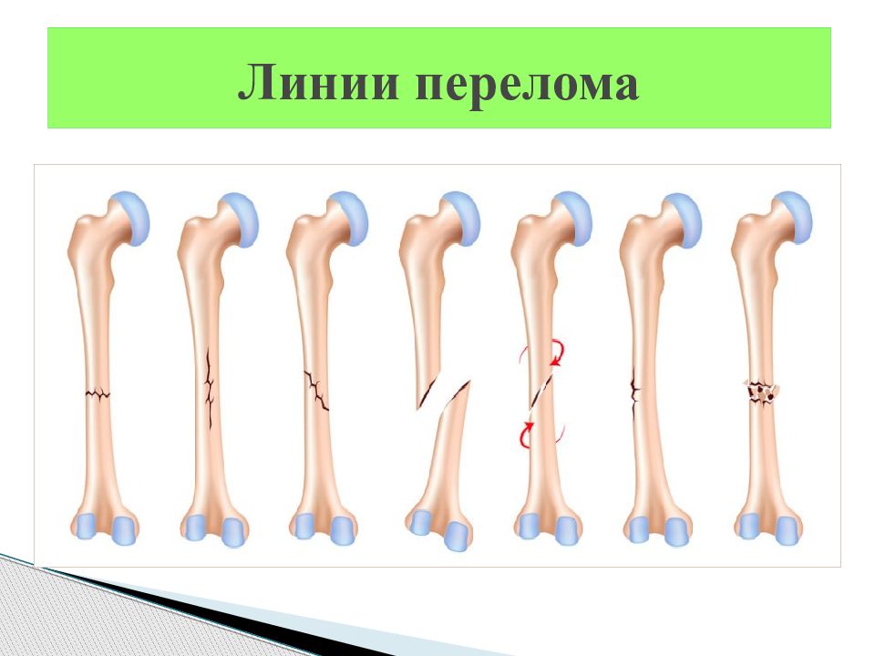 Полная кость. Переломы по форме и направлению. Переломы классификация по направлению линии.