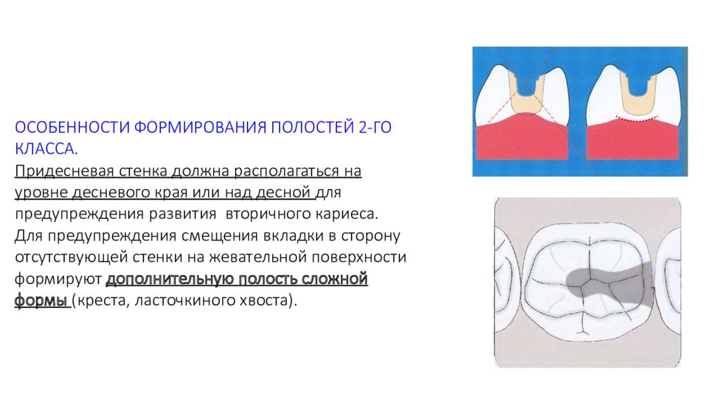 Характеристика полостей. Десневая стенка полости 2. Придесневая стенка кариозной полости II класса формируется. Варианты формирования десневой стенки в полости 2 класса. Придесневая стенка кариозной полости.