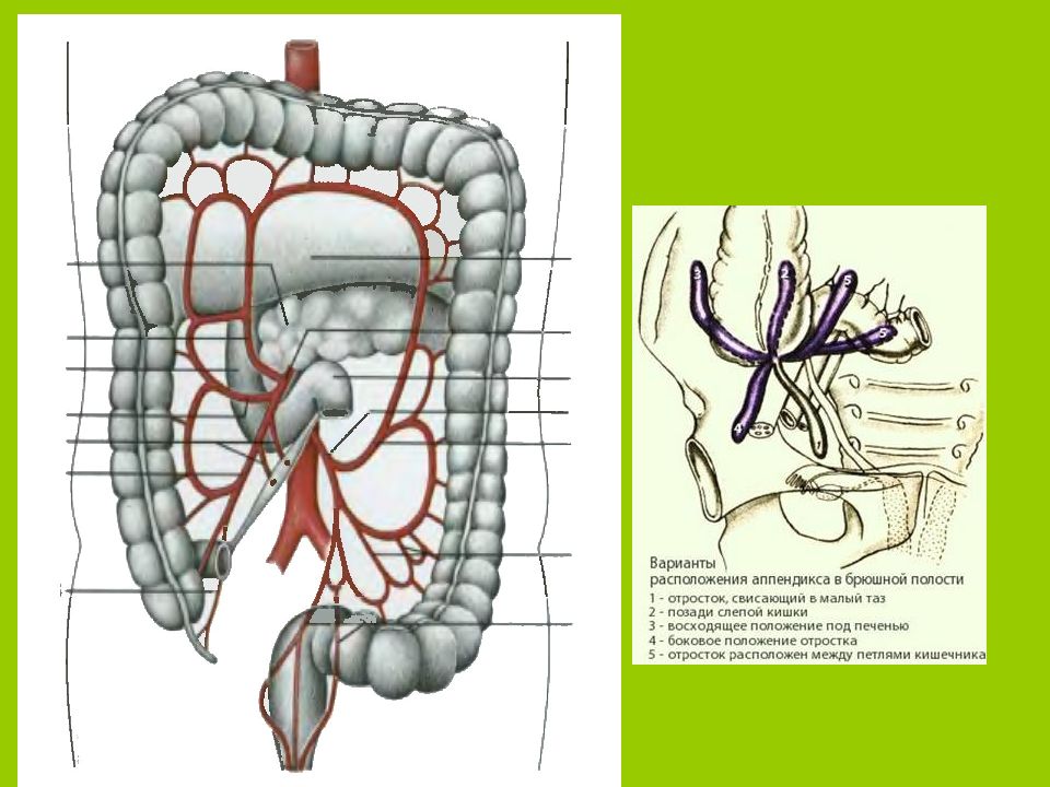 Аппендикс отросток какой. Варианты расположения аппендикса. Варианты расположения червеобразного отростка в брюшной полости.