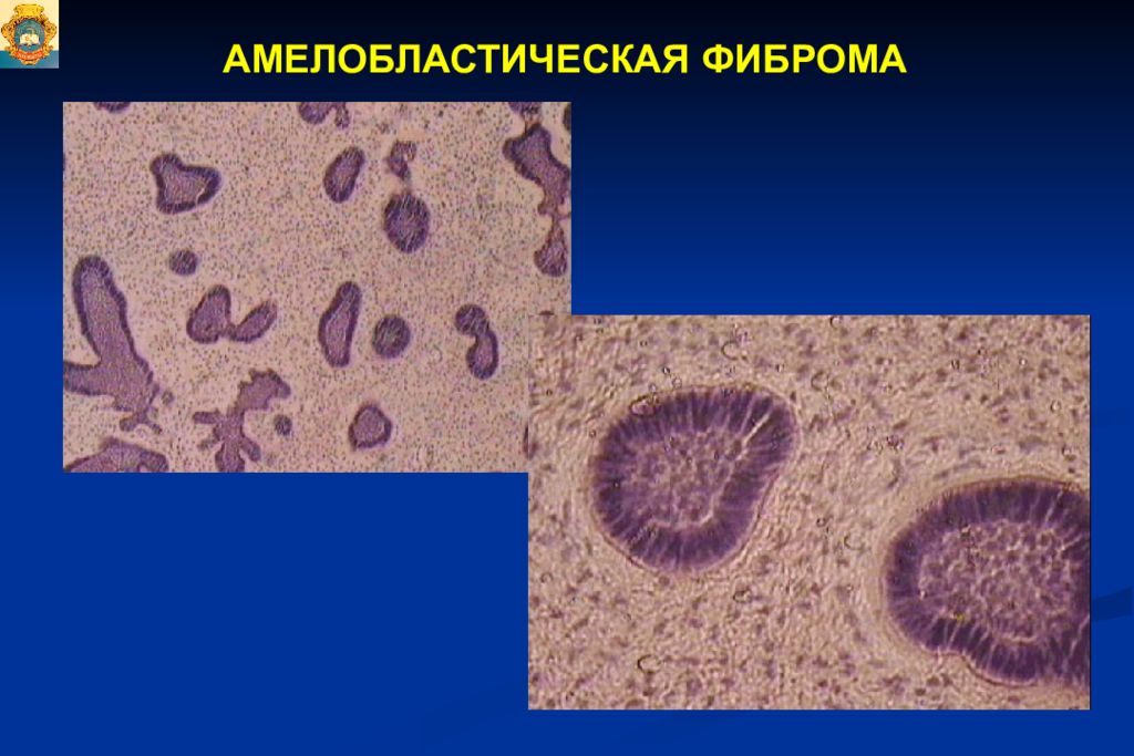 Опухоли опухолеподобные поражения и кисты кожи лица презентация