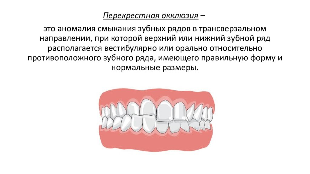 Окклюзия. Перекрестный прикус классификации перекрестного прикуса. Вестибуло перекрестный прикус. Перекрестный прикус боковых зубов. Лингвальный и буккальный перекрестный прикус.