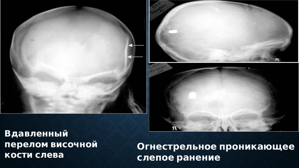 Дырчатый перелом. Оскольчатый перелом височной кости. Линейный перелом пирамиды левой височной кости. Линейный перелом височной кости на кт. Линейный перелом чешуи височной кости.