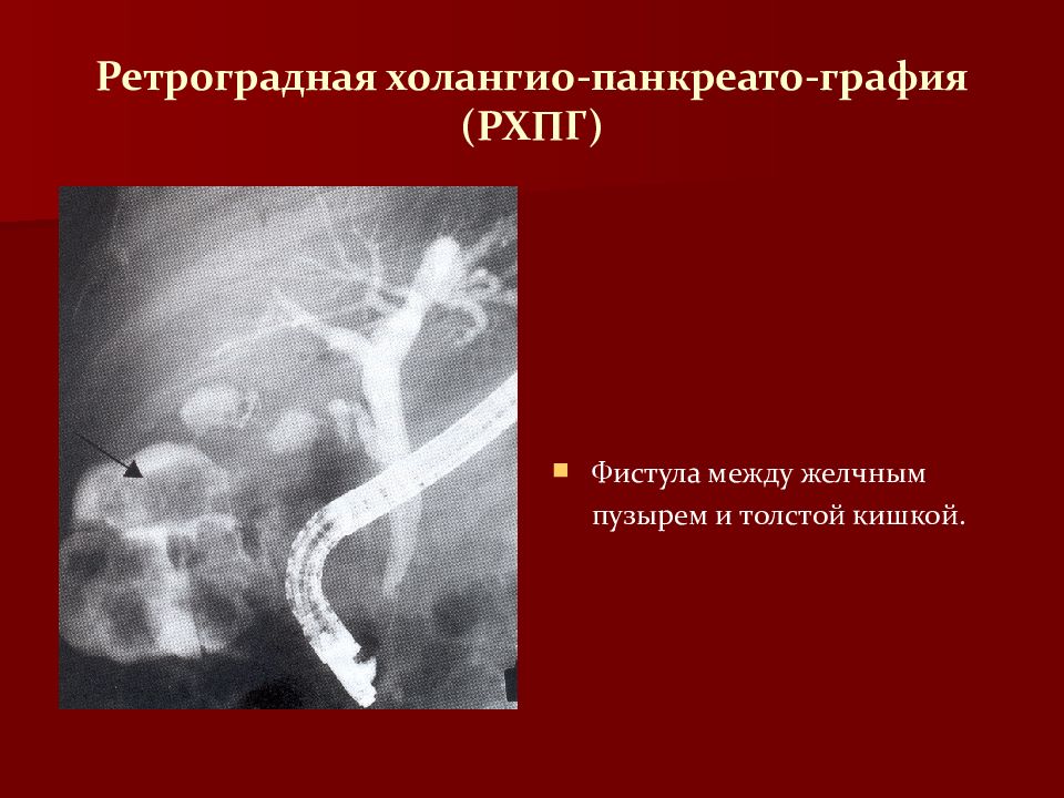 Синдром мириззи презентация