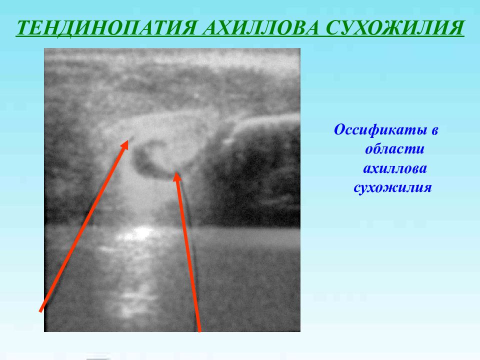 Тендинопатия что это. Тендинопатия ахиллова сухожилия. Оссификация ахиллова сухожилия рентген. Разрыв ахиллова сухожилия на УЗИ протокол. Тендинопатия хамстрингов зона боли.