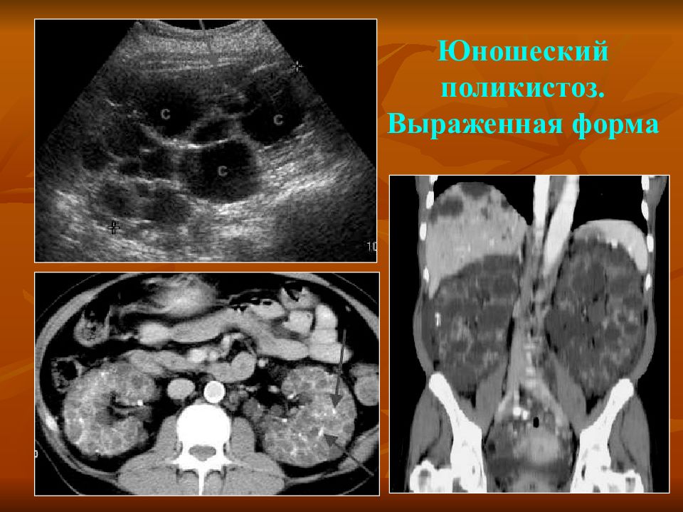 Поликистоз инфильтративного типа мелкокистозного типа дает эхографическую картину