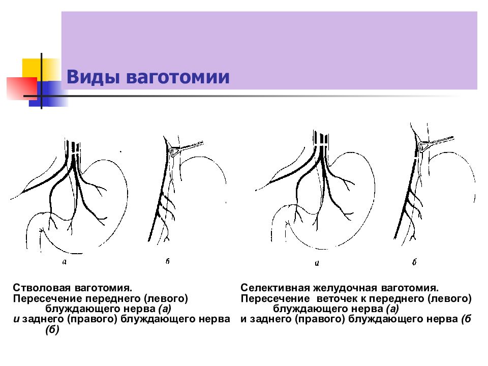 Болезни оперированного желудка презентация