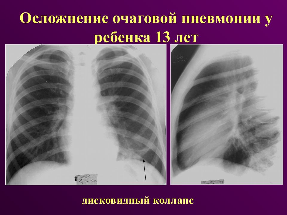 Осложнения пневмонии у детей презентация