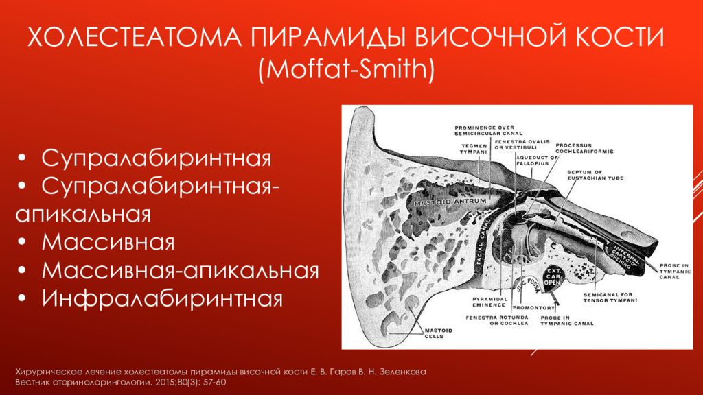 Пирамиды височной. Холестеатома пирамиды височной кости. Холеастома височной кости. Пирамиды височных костей. Холестеатома пирамиды височной кости кт.