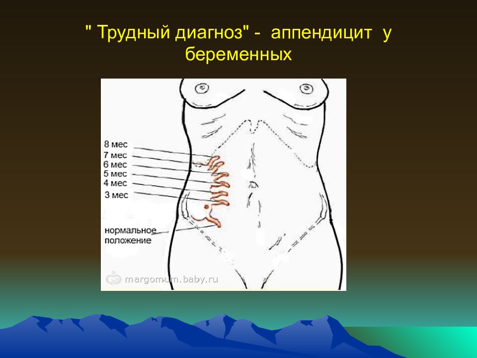 Острый аппендицит острый живот презентация