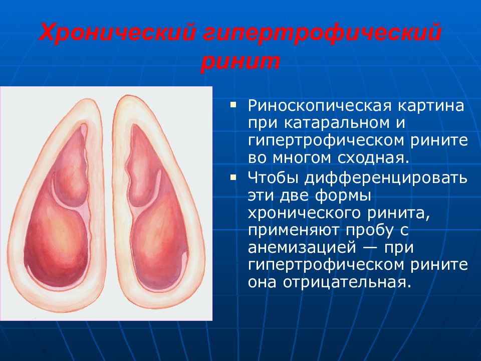 Хронический ринит презентация