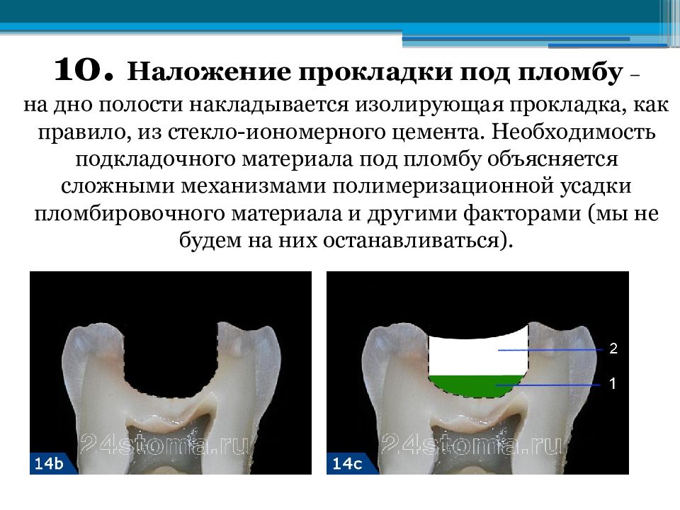 Схема наложения лечебных прокладок