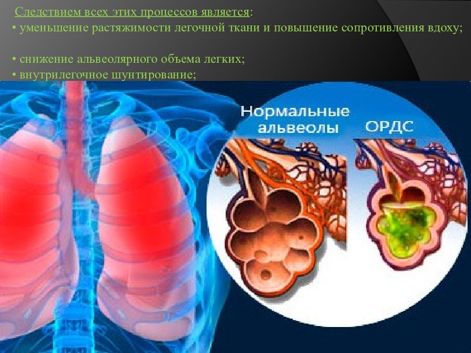 Респираторный синдром у взрослых что это. О́стрый респирато́рный дистре́сс-синдро́м (ОРДС). Экссудативная фаза ОРДС. Респираторный дистресс-синдром взрослых. Острый респираторный дистресс-синдром взрослых.