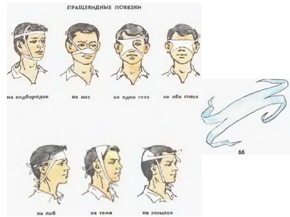 Пращевидная повязка. Пращевидная повязка техника. Наложение пращевидной повязки на нос алгоритм. Пращевидная повязка на голову алгоритм. Пращевидная повязка на глаз.