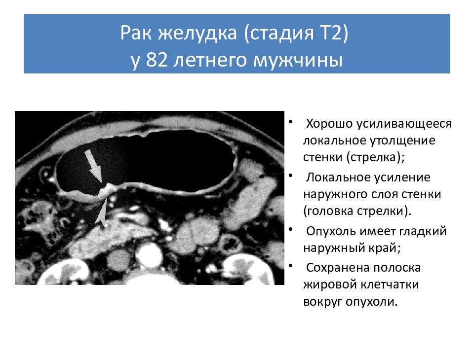 Рак желудка презентация по хирургии