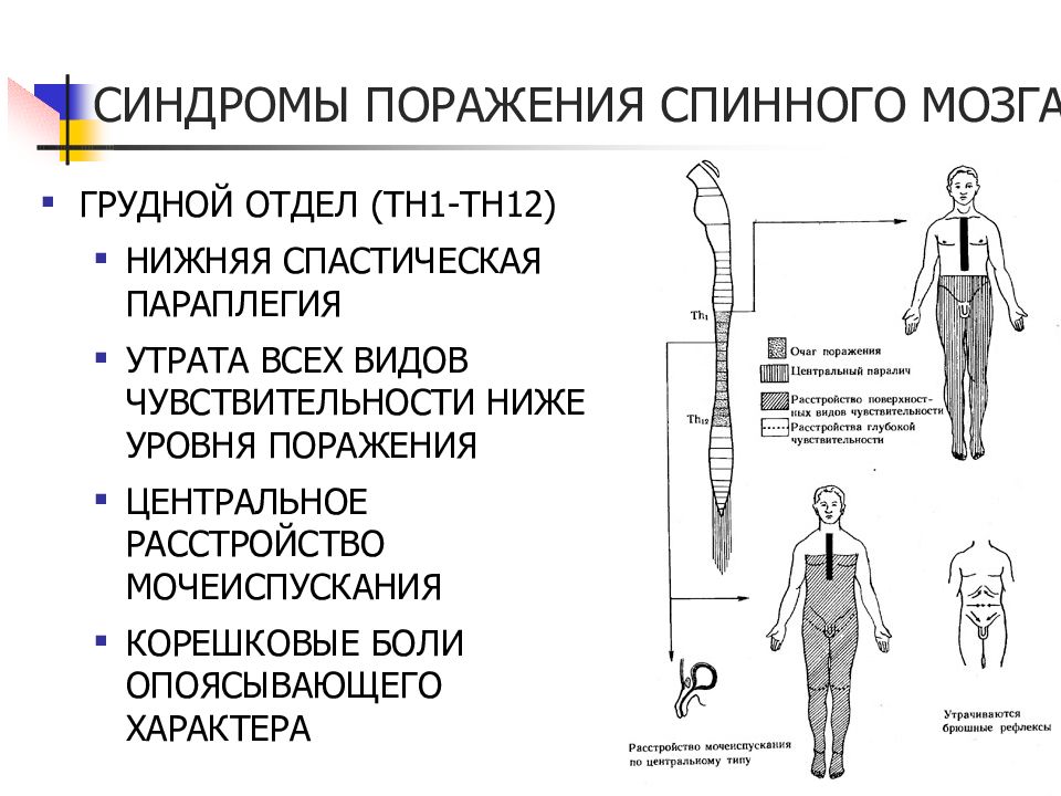 Исследование см. Поражение грудного отдела спинного мозга. Синдром поражения грудного отдела спинного мозга. Поражение спинного мозга на уровне грудного отдела. Уровень поражения спинного мозга таблица.