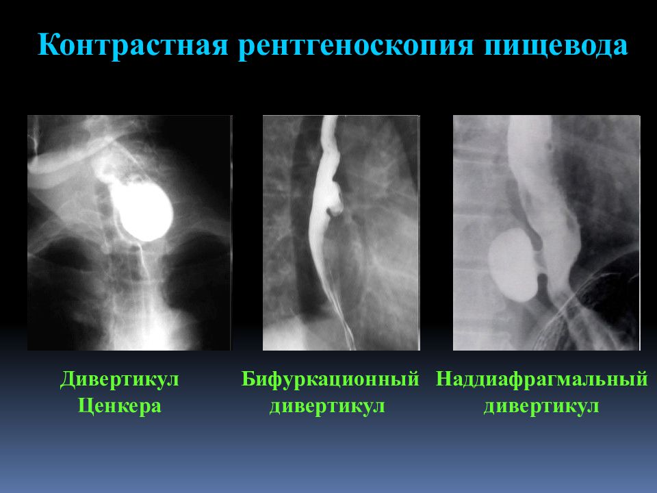 Рентгеноскопия пищевода. Дивертикул пищевода Ценкера рентген. Ценкеровский дивертикул. Дивертикул Ценкера рентген. Дивертикул Ценкера рентгеноскопия.