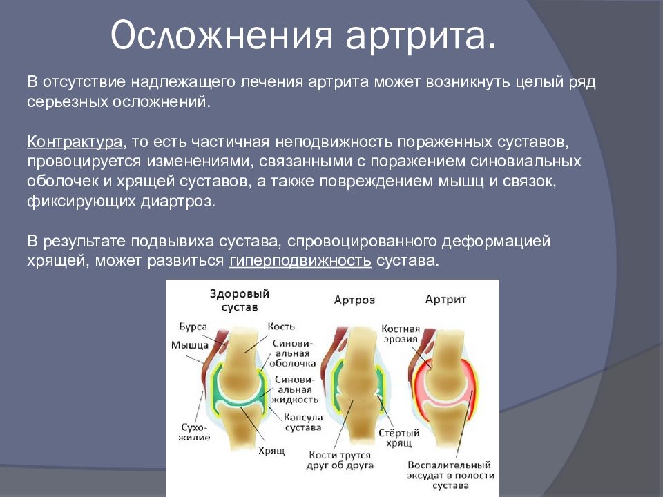 Презентация на тему артроз