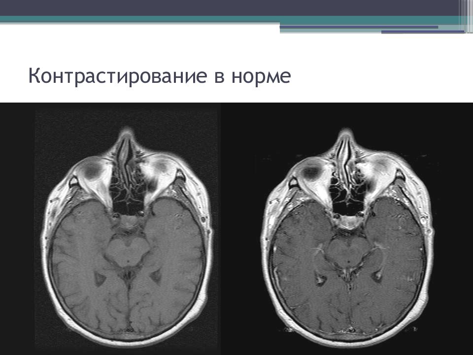 Контраст для мрт. Контрастные препараты для мрт. Контрастирование при мрт что это. Магнитно резонансные контрастные средства. Контрасты для мрт презентация.