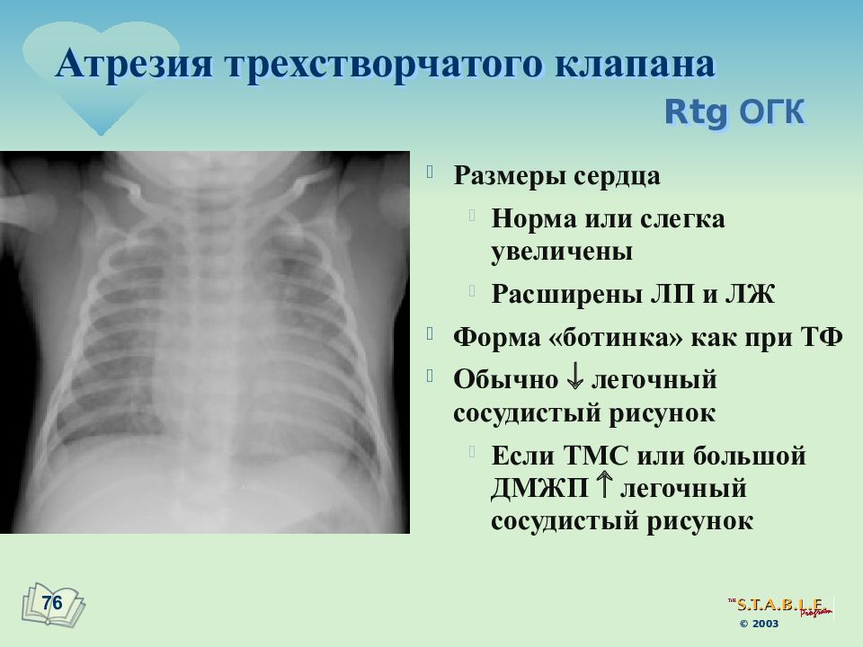 Атрезия трехстворчатого клапана презентация