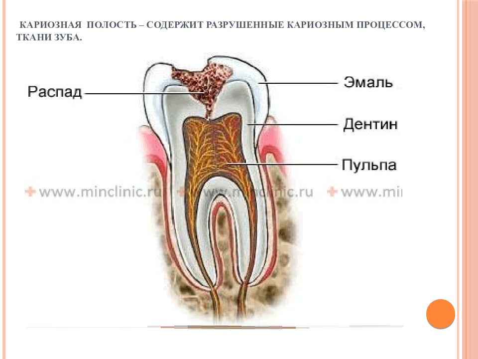 Полость содержать. Кариес дентина мкб 10. Дентин зуба разрушилась.