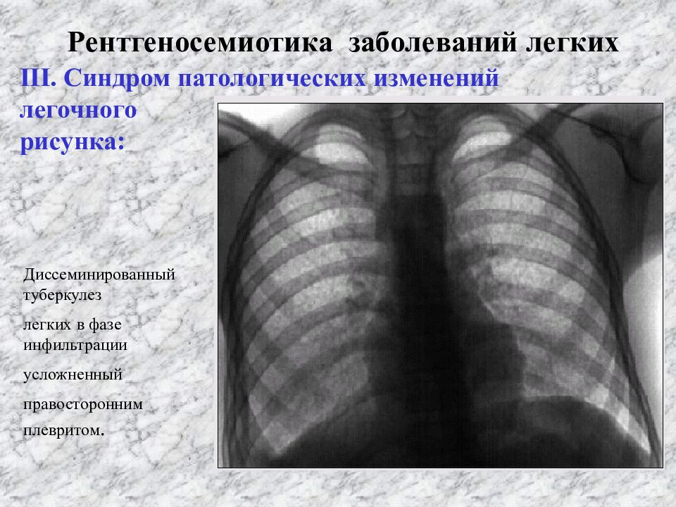 Синдромы поражения легких. Диссеминированный туберкулез флюорография. Диссеминированный туберкулез рентгенологические синдромы. Диссеминированный туберкулёз лёгких рентген. Синдром патологии легочного рисунка туберкулез.