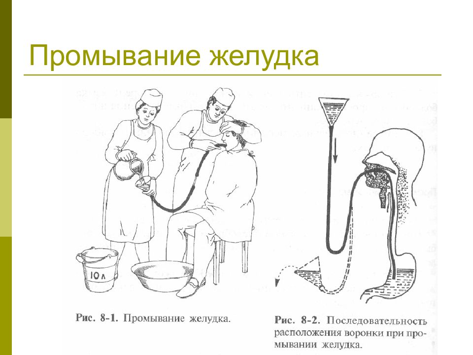 Промывание желудка водой. Манипуляция промывание желудка алгоритм. Зондовое промывание желудка оснащение. Составление схемы – алгоритма «промывание желудка».