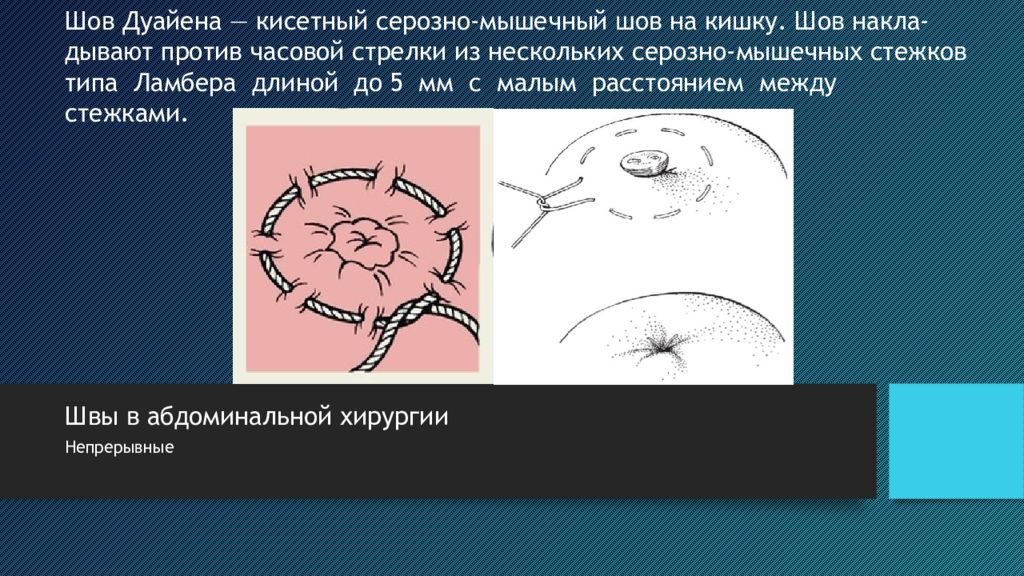 Круговой шов. Кисетный шов в хирургии Ветеринария. Кисетный шов (шов Дуайена). Кисетный шов по автору.