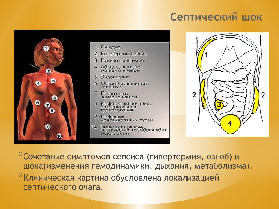 Сепсис септический шок. Клиническая картина септического шока. Септический ШОК клинические проявления. Септический ШОК презентация.