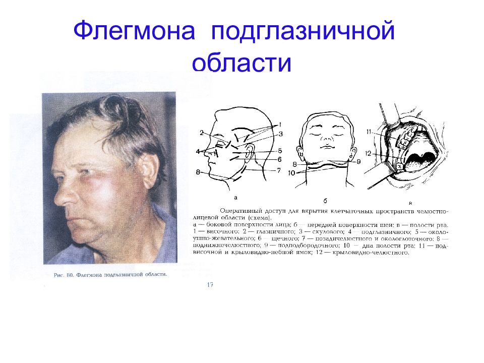 Схема вскрытия разлитой флегмоны височной области