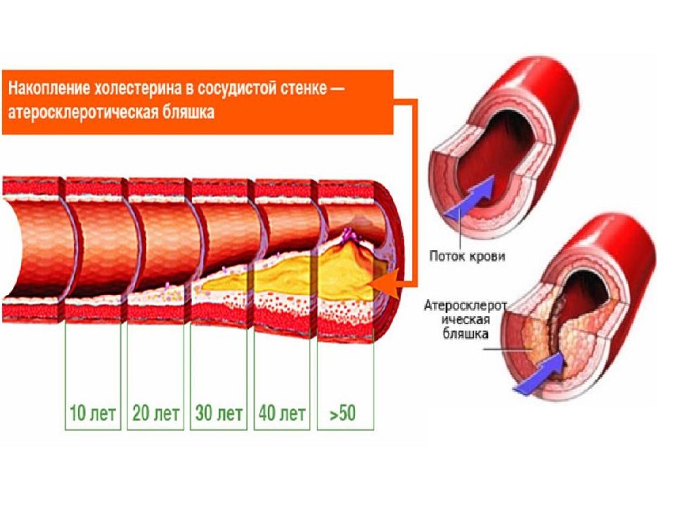 Повреждения сосудистой стенки. Строение сосудистой стенки. Накопление холестерина в сосудистой стенке. Строение стенки кровеносных сосудов. Изучить строение сосуды,.