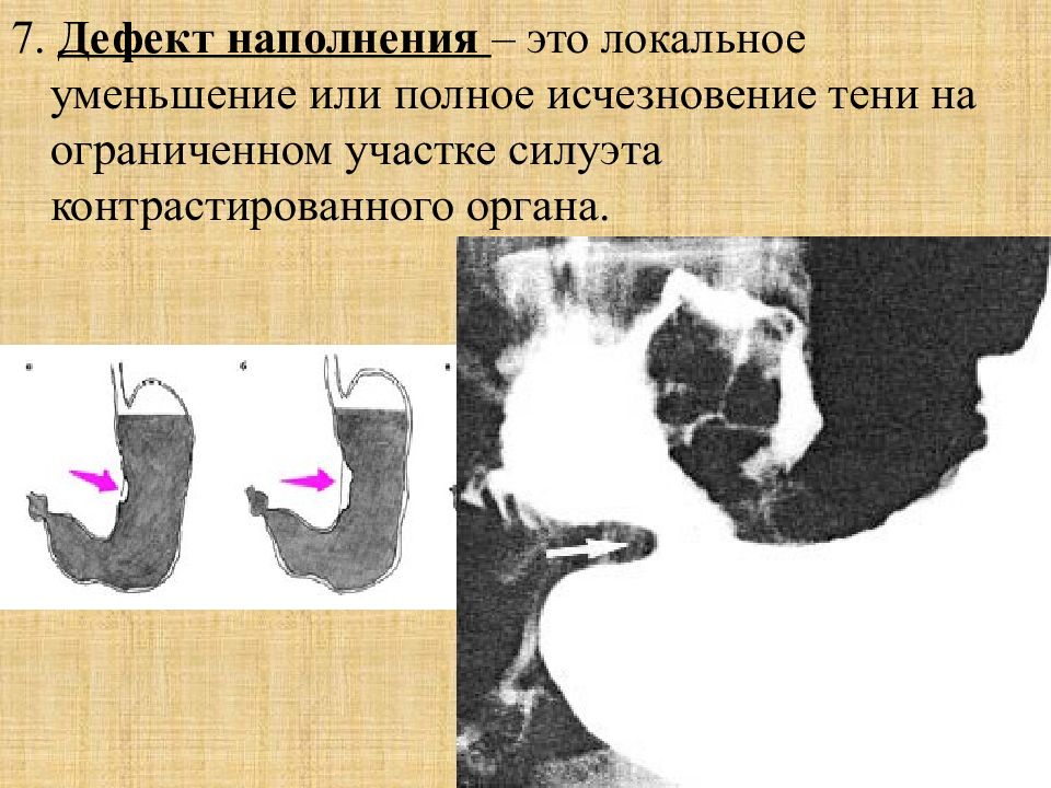 7 дефект. Краевой дефект наполнения желудка рентген. Дефект наполнения кишечника рентген. Дефект наполнения желудка рентген. Дефект наполнения толстой кишки.