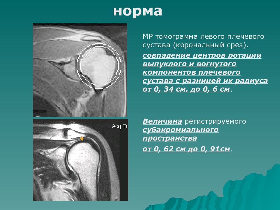 Мрт плечевого. Мрт анатомия плечевого сустава. Аксиальная анатомия плечевого сустава мрт. Кт плечевого сустава норма. Сумки плечевого сустава мрт.