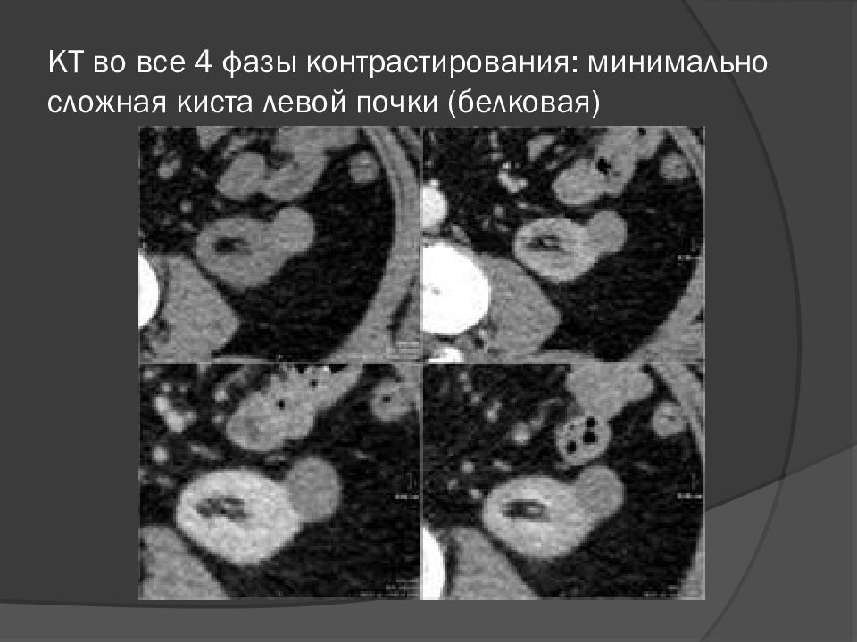 Киста лево. Сложная киста почки кт. Кисты почек при контрастировании. Белковая киста почки кт. Сложные кисты почек мрт.