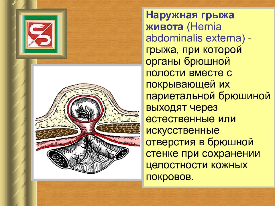 Грыжи передней брюшной стенки презентация