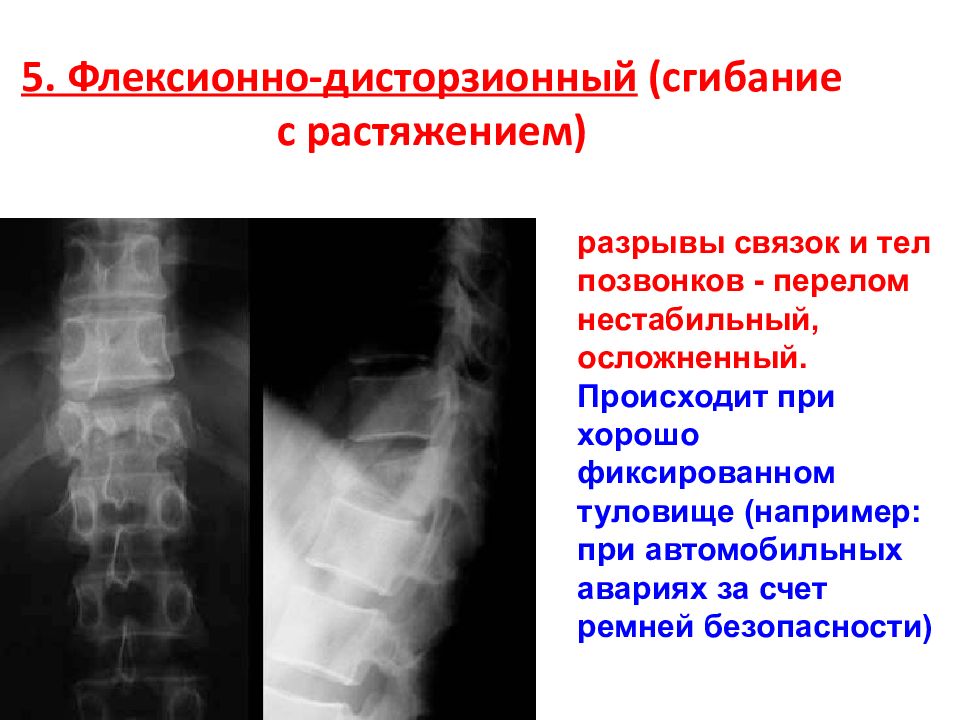 Перелом тела позвонка. Флексионный перелом позвоночника. Флексионно дистракционный перелом позвоночника. Флексионно ротационный перелом. Ротационный перелом позвоночника.