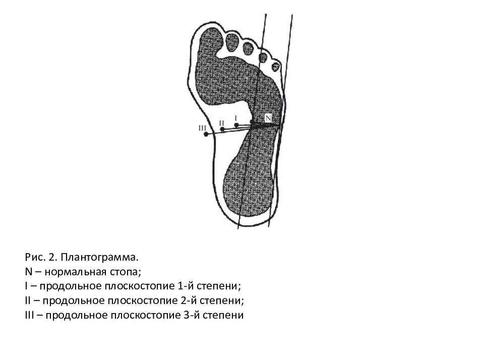 Плантограмма стопы