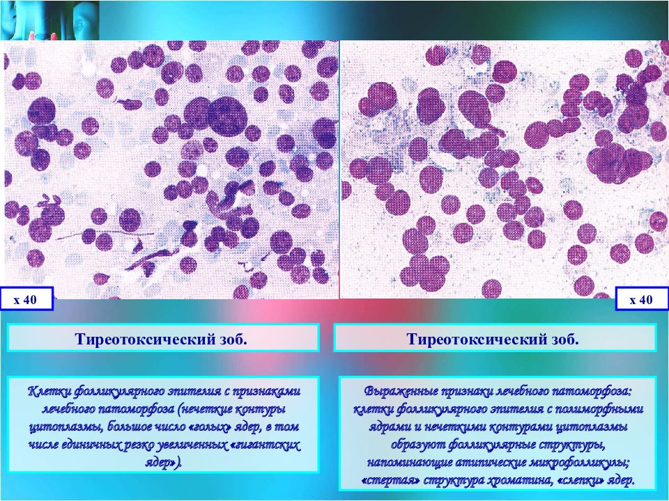 Цитологическая картина фолликулярной опухоли щитовидной железы что значит