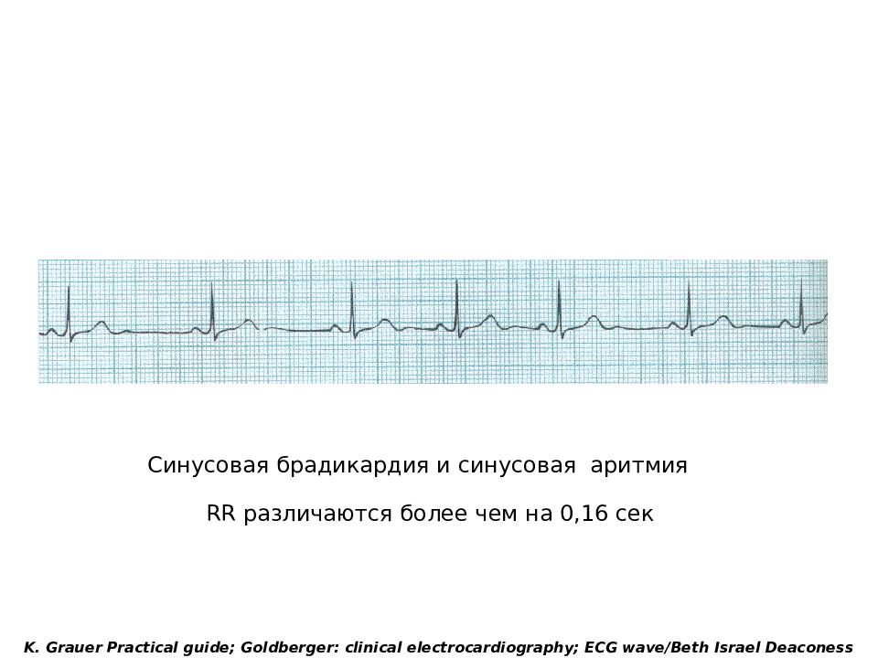 Что значит синусовый ритм сердца на экг. Синусовая аритмия на ЭКГ У подростка 16 лет что это. ЭКГ брадикардия синусовый ритм. Синусовая аритмия на ЭКГ. Заключение ЭКГ синусовая аритмия.